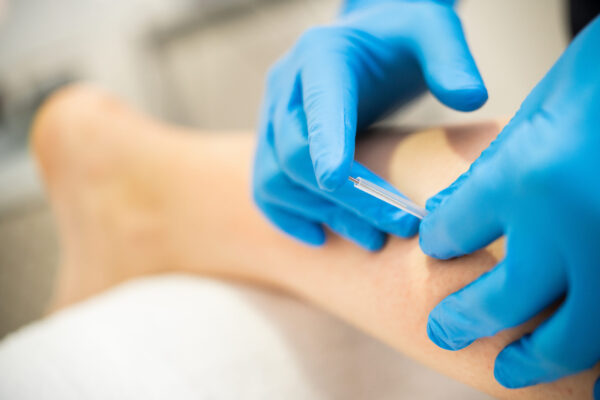 Trigger Point Dry Needling (TPDN)